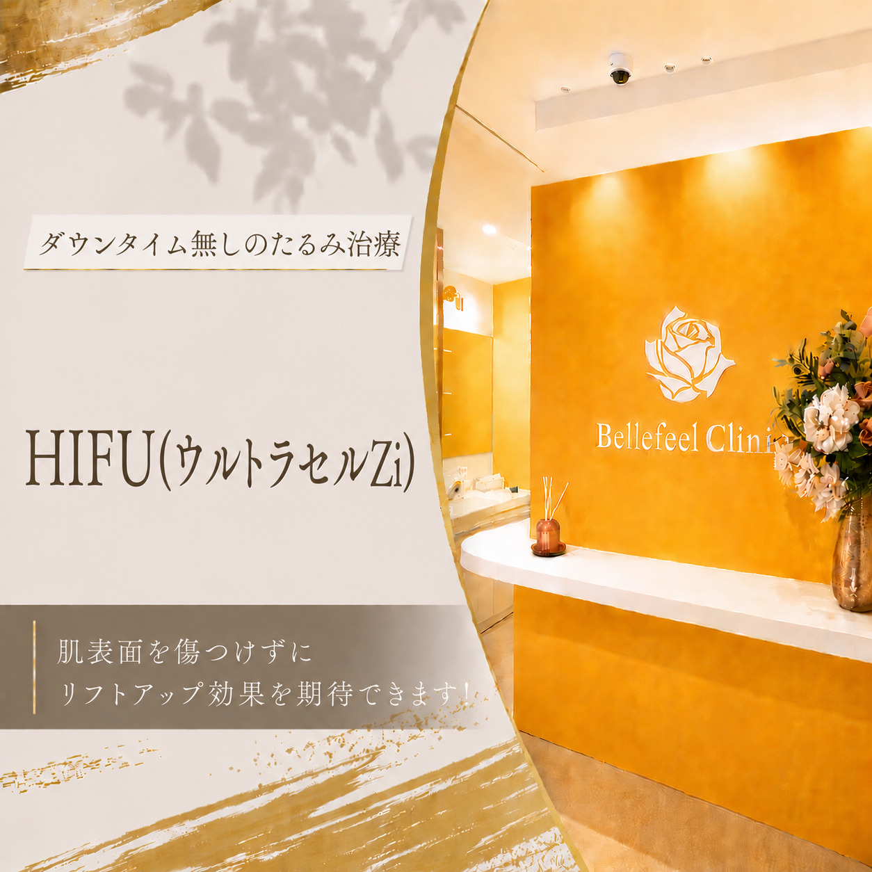 ダウンタイム無しのたるみ治療👑HIFU(ウルトラセルZi)
